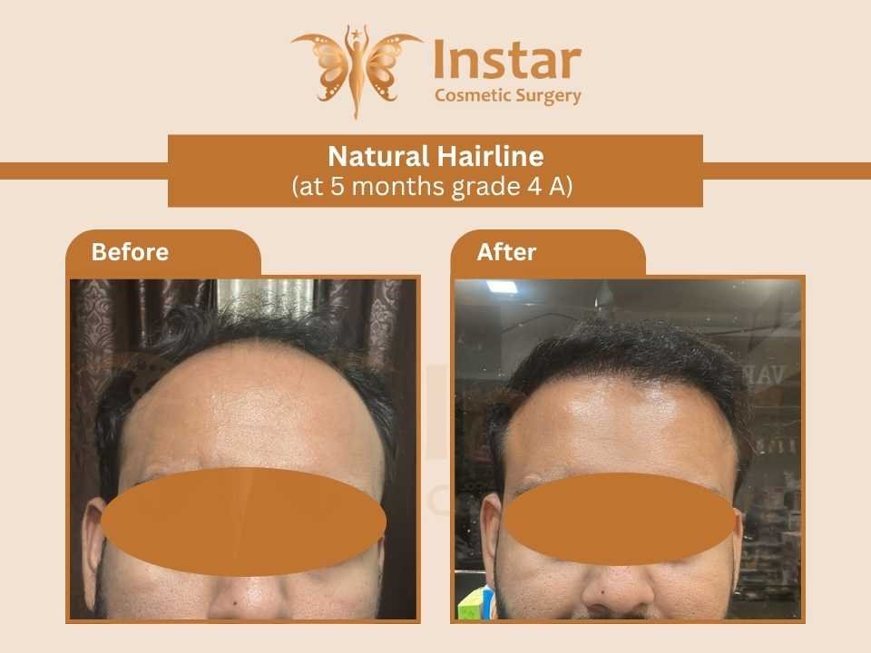 Natural Hairline (at 5 months grade 4 A)